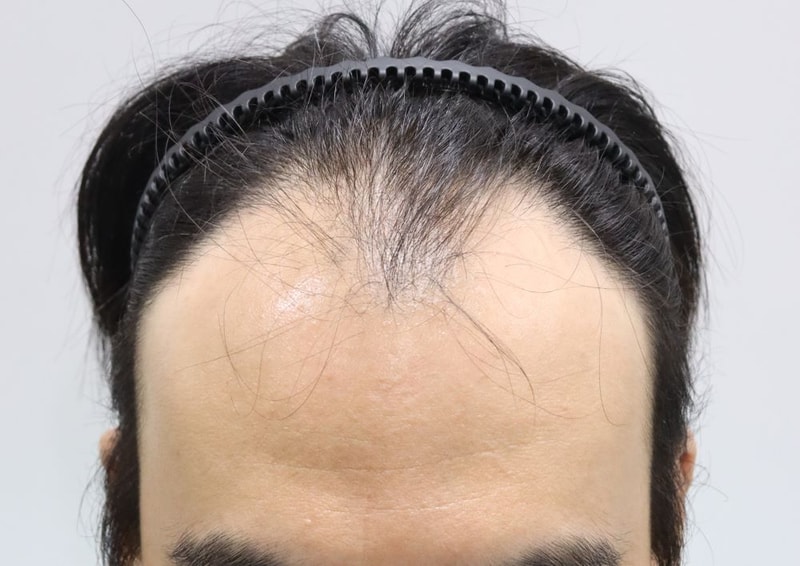 압구정 포헤어 비절개슬릿 모발이식 2300모낭 대량이식 수술당일 후기