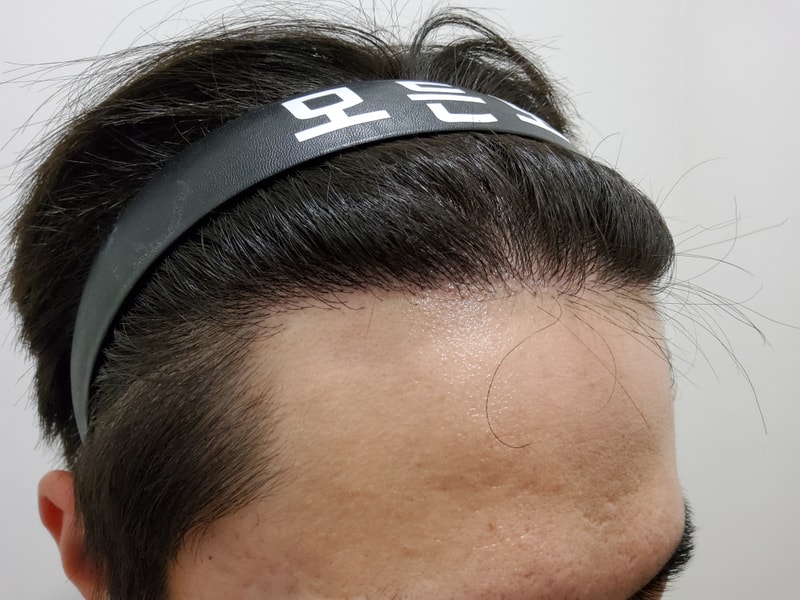 4. 수술후_1년_3.jpg