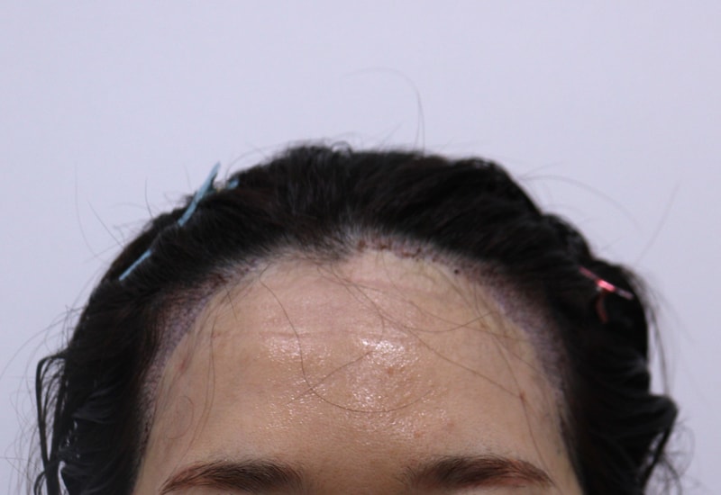 2. 수술후_1일_1.JPG