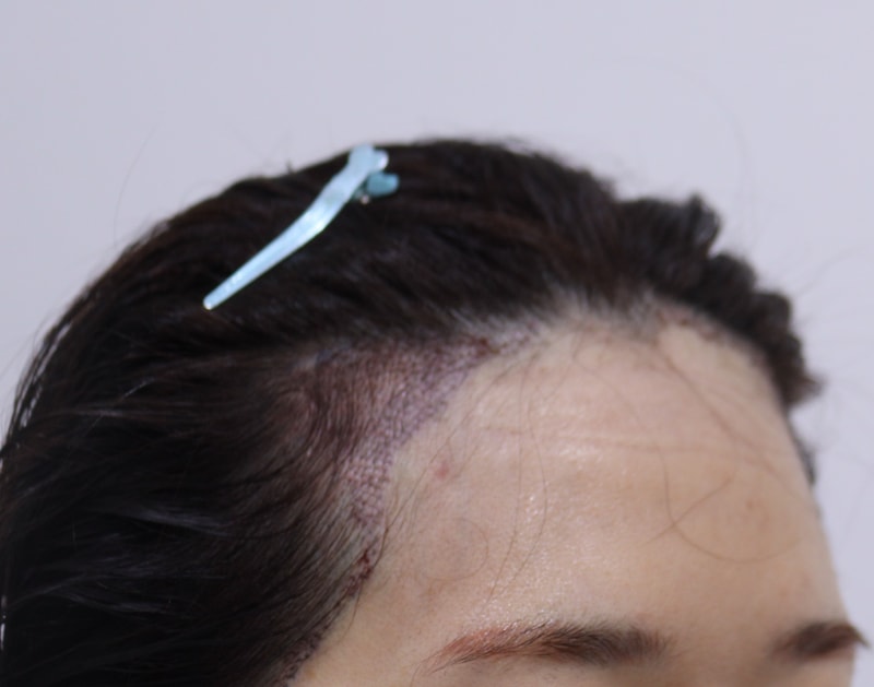 2. 수술후_1일_3.JPG