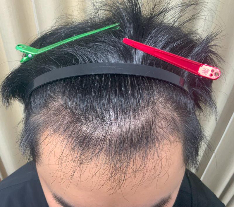 2500모 이식 3mo.png