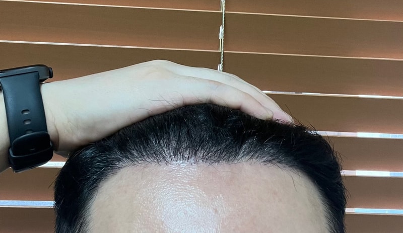4. 수술후_6개월_셀카_1.jpg
