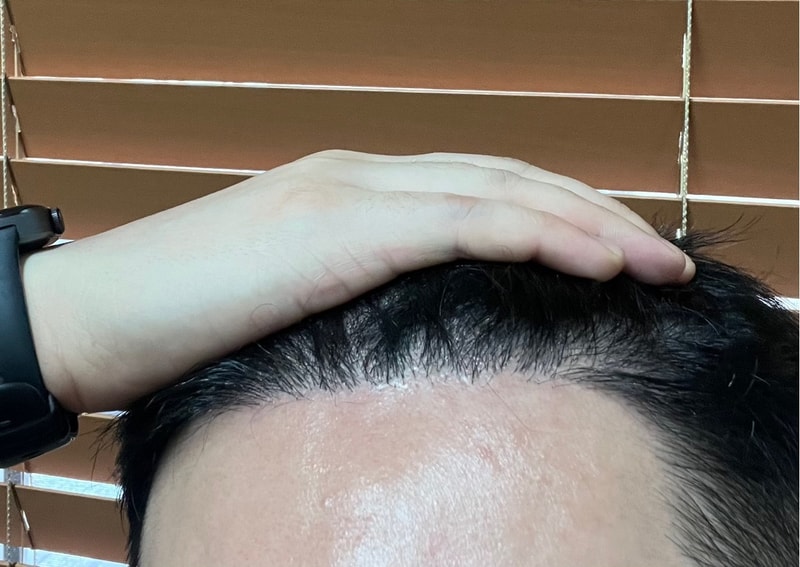 4. 수술후_6개월_셀카_2.jpg
