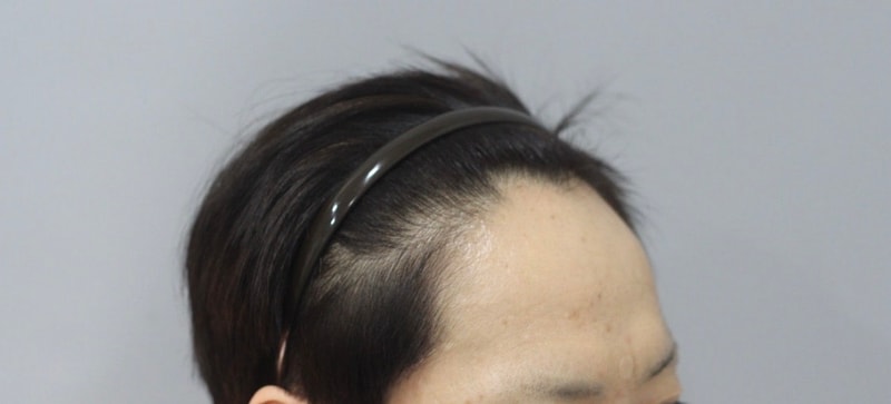 압구정 모건피부과 비절개 포토 후기입니다