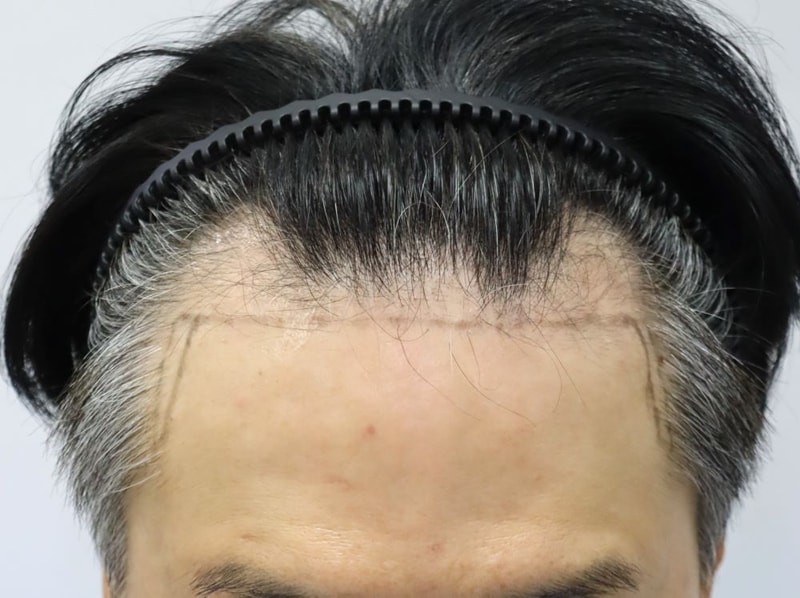 압구정 포헤어의원 40대 M자탈모 비절개슬릿 모발이식 7개월 후기
