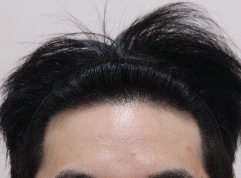 4. 수술후_1년_1.JPG