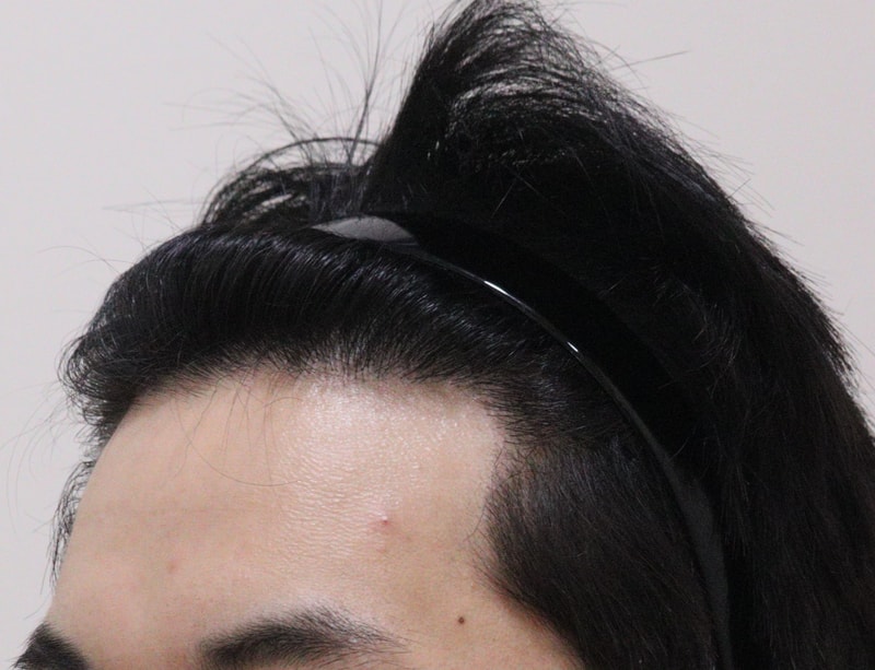 4. 수술후_1년_2.JPG