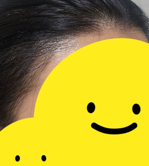 모발이식 1년 후 