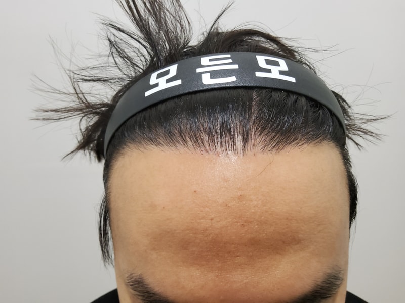 3. 수술후_1년_1.jpg