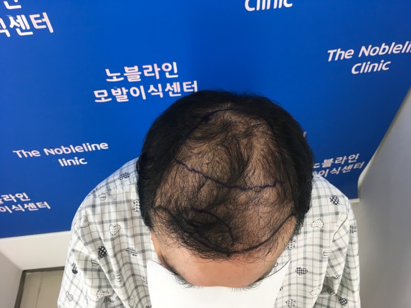 대량모발이식 20일차 입니다.