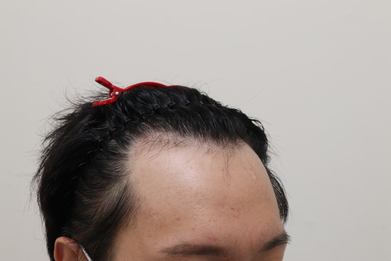 1. 수술전_3.JPG