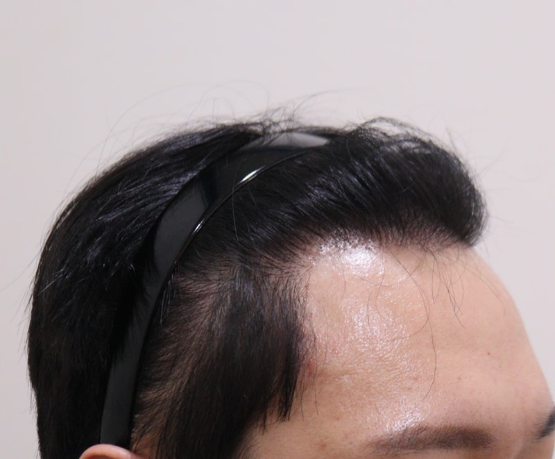 4. 수술후_1년_3.JPG