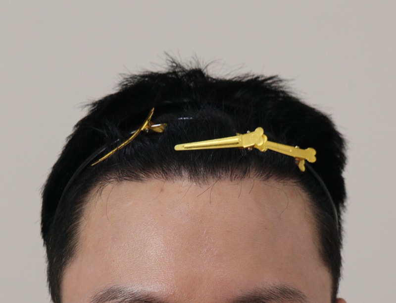 4. 수술후_1년_1.JPG