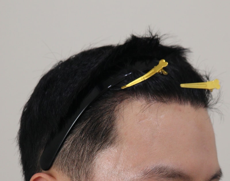 4. 수술후_1년_3.JPG