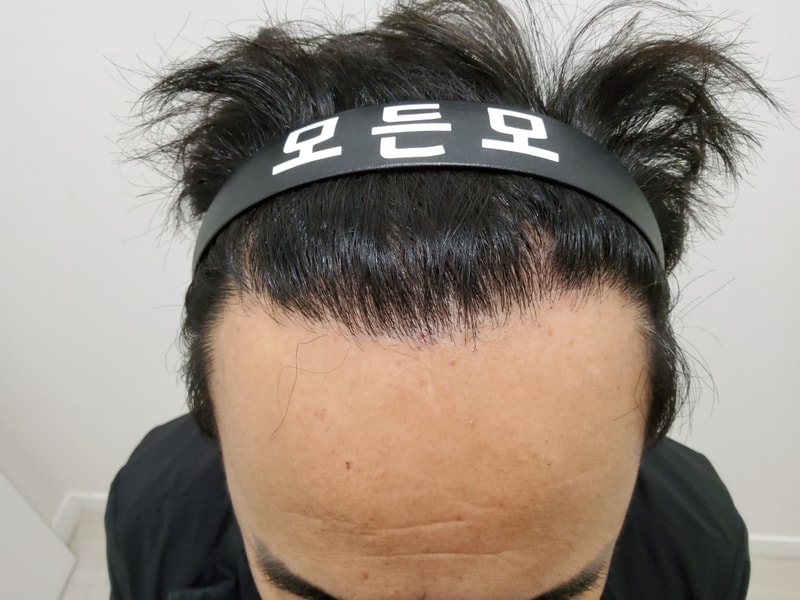 5. 수술후_1년_2.jpg