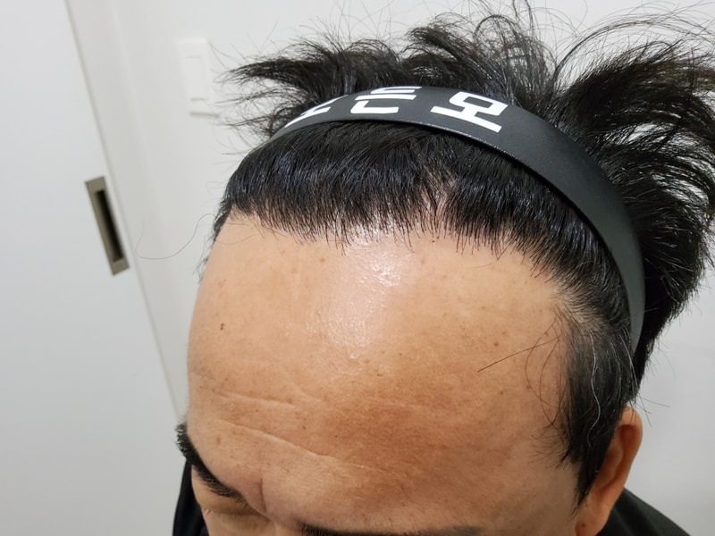 5. 수술후_1년_3.jpg