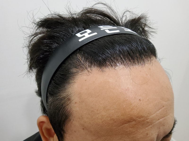 5. 수술후_1년_4.jpg