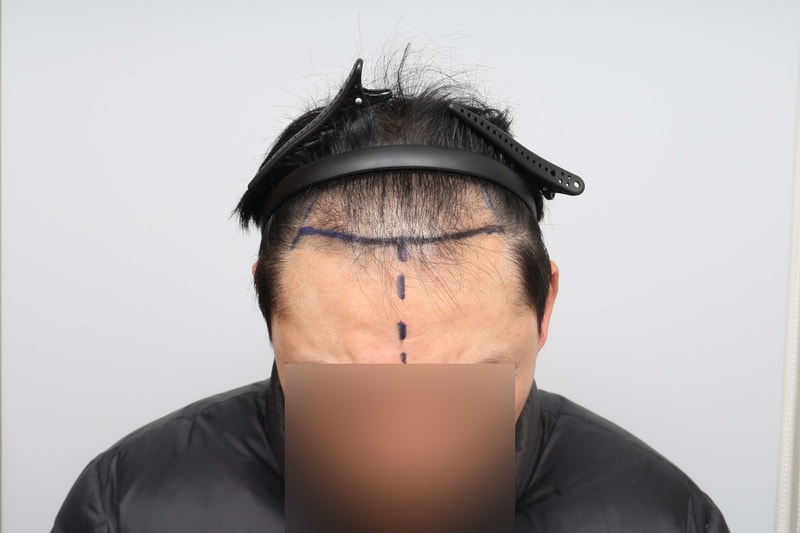 ⭐⭐수술전디자인의-사본.jpg
