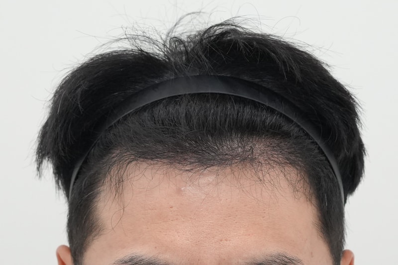 6개월경과.jpg