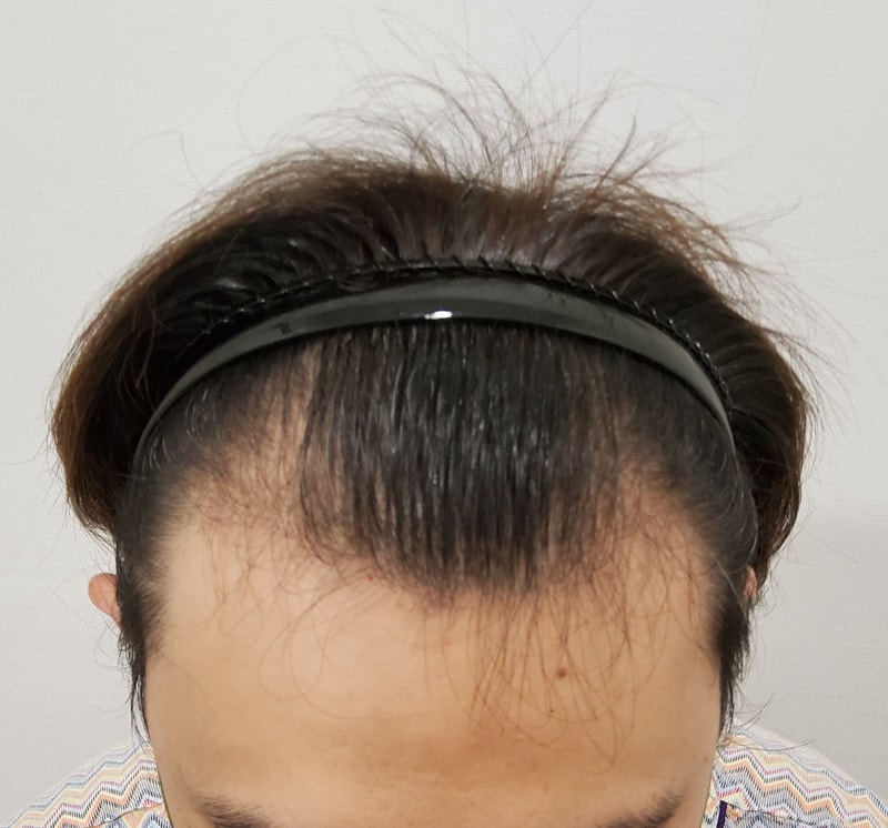 1. 수술전_2.jpg