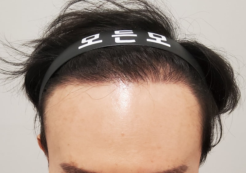 5. 수술후_1년_1.jpg