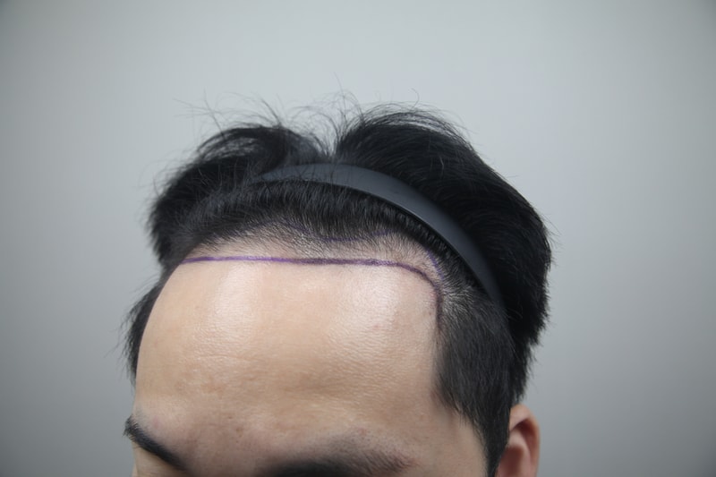 이식 전 2.jpg