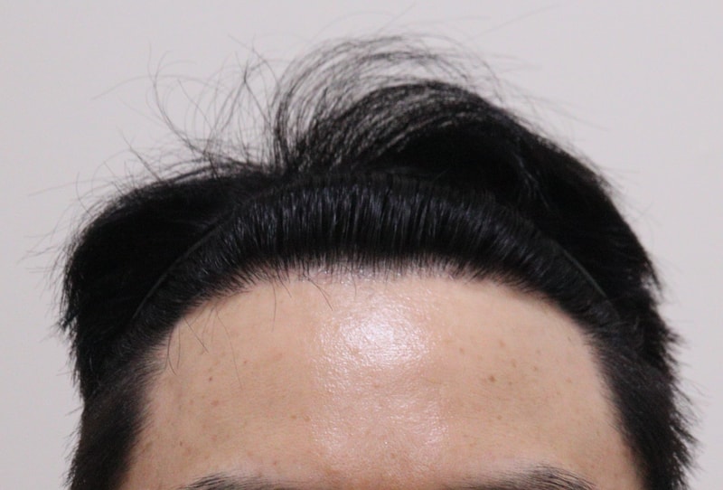 4. 수술후_1년_1.JPG