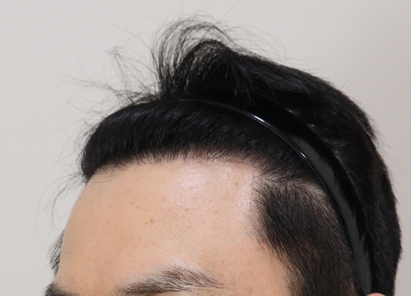 4. 수술후_1년_2.JPG