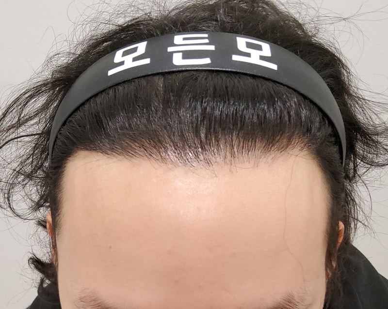 4. 수술후_1년_1.jpg