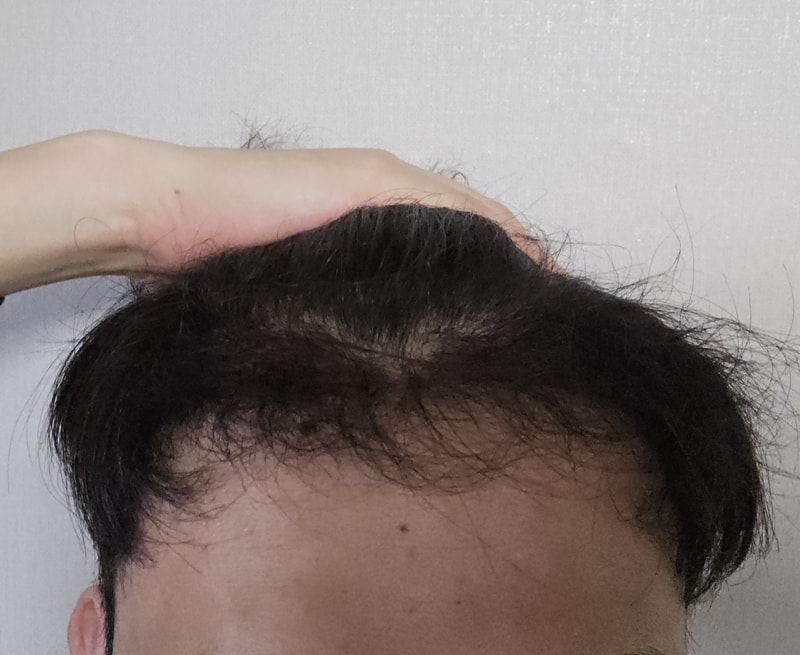 4. 수술후_6개월.jpg