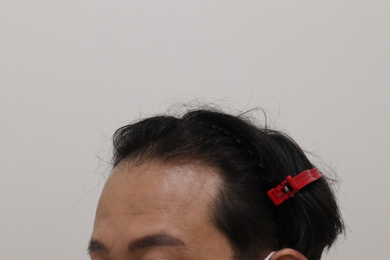 1. 수술전_2.JPG