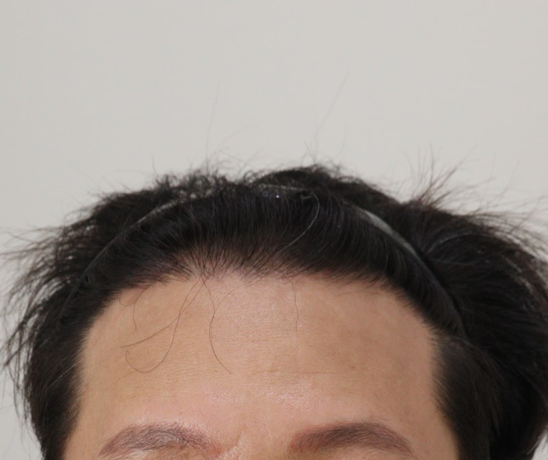 4. 수술후_1년_1.JPG
