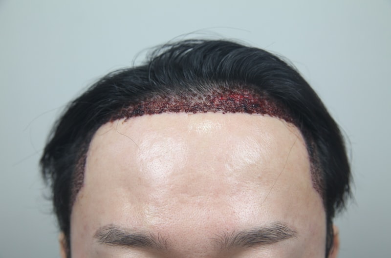 수술 1일차.jpg