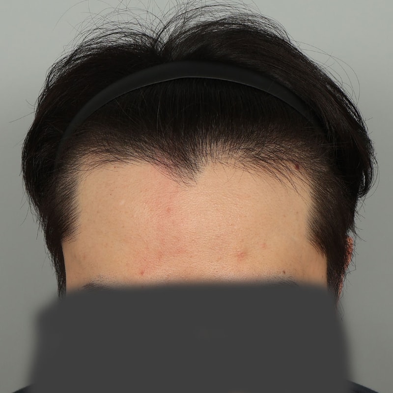 서진성형외과 물결 디자인 모발이식 후기