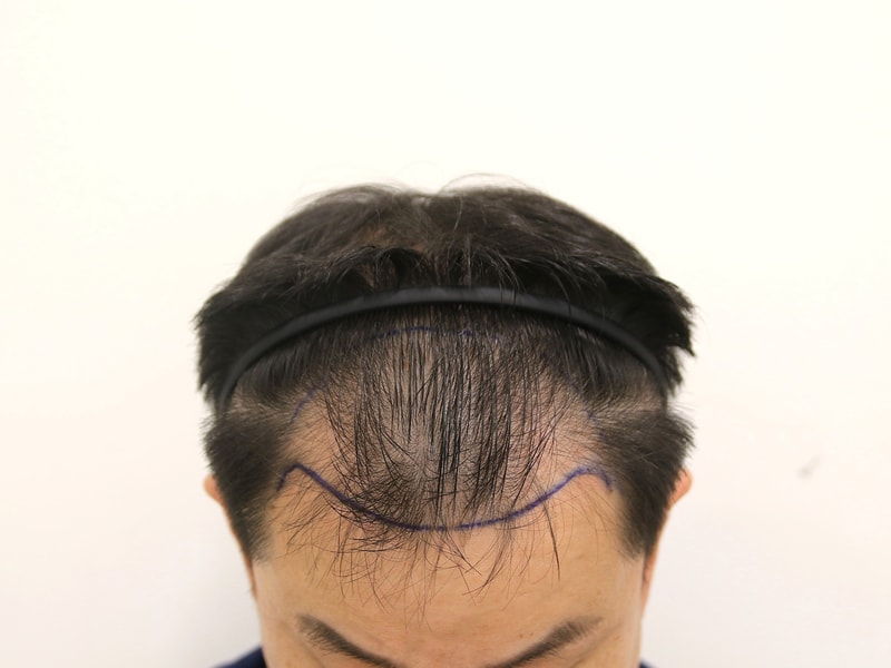 시술전.jpg