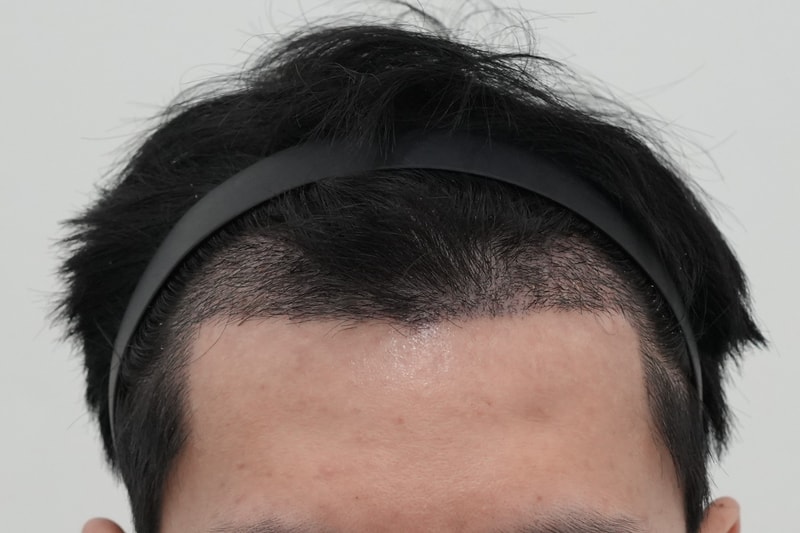 수술2주차.jpg