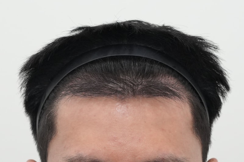 수술3개월암흑기1.jpg