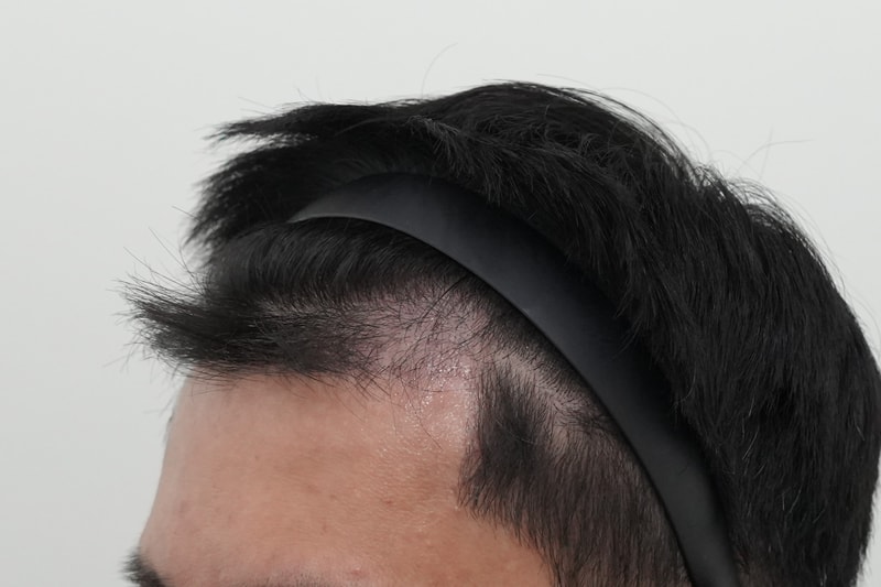 수술3개월암흑기2.jpg