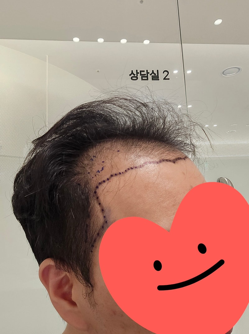 시술전22.jpg