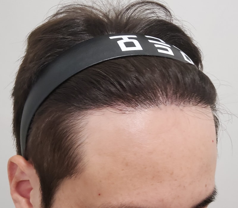 5. 수술후_1년_3.jpg