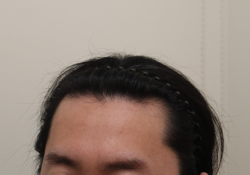 1. 수술전_3.JPG
