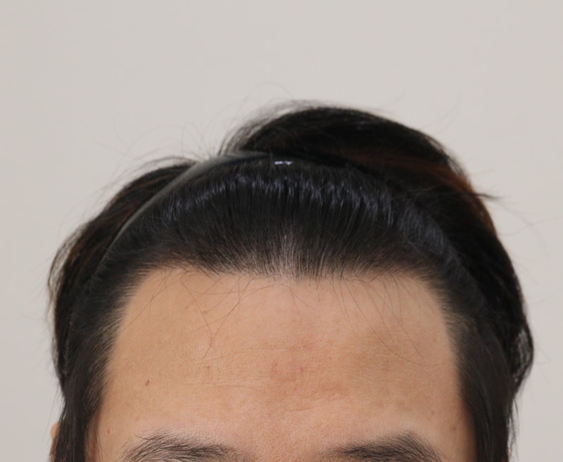 4. 수술후_1년_1.JPG