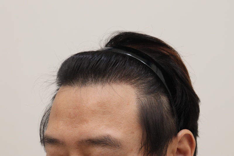 4. 수술후_1년_2.JPG