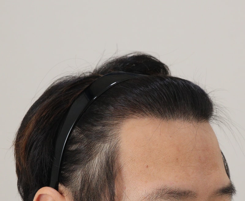 4. 수술후_1년_3.JPG