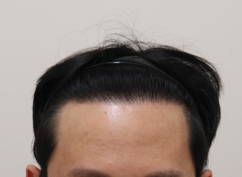 4. 수술후_1년_1.JPG