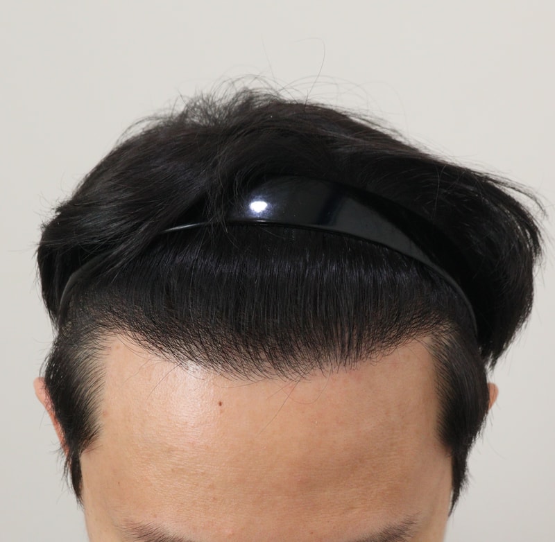 4. 수술후_1년_2.JPG