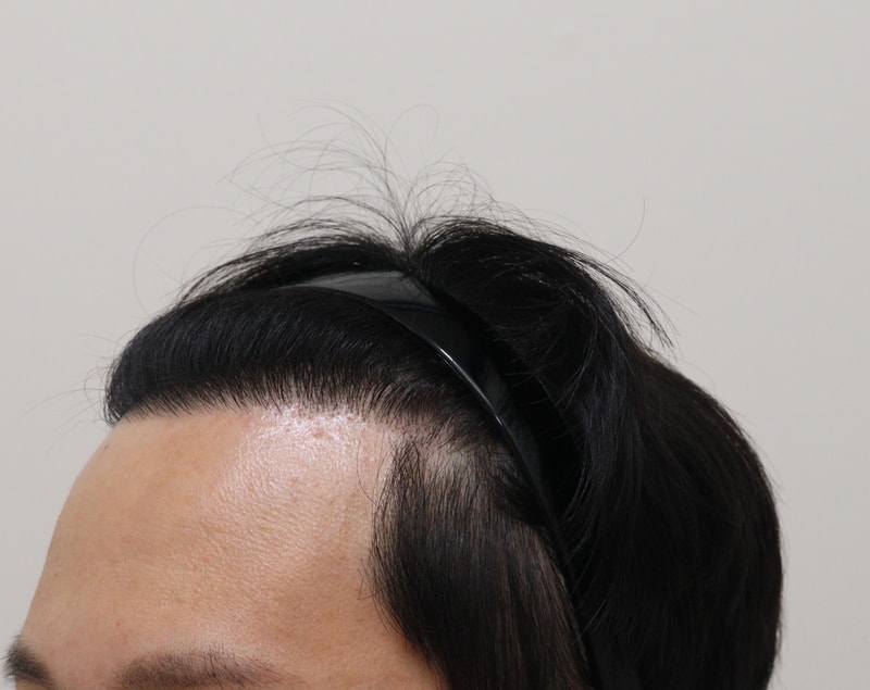 4. 수술후_1년_3.JPG
