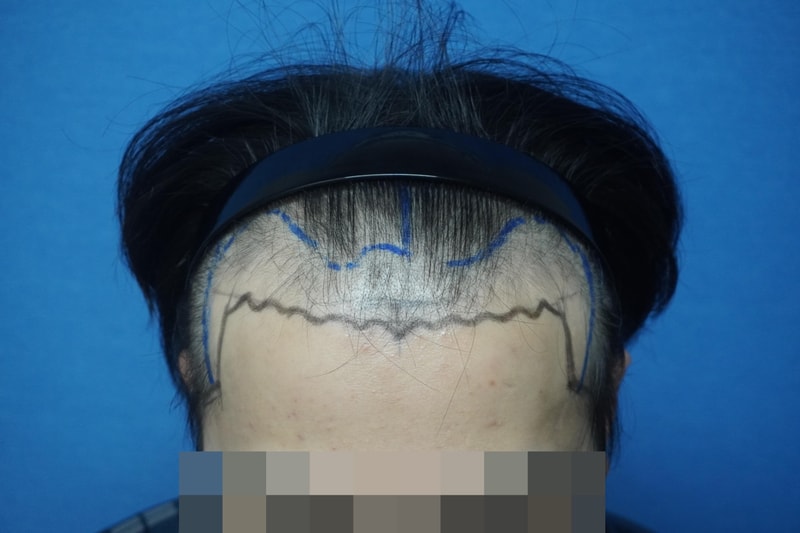 모바름미작의원 모발이식 1년 차 후기 자연스러워서 만족합니다
