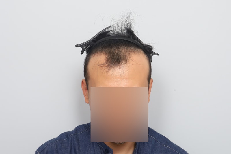 수술전-(5).jpg