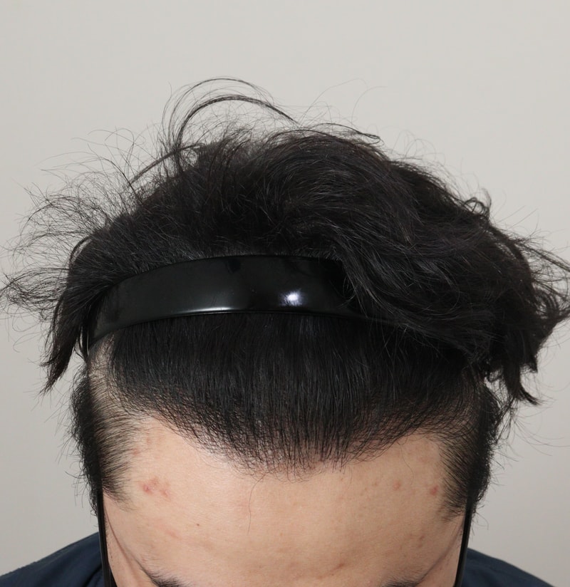 4. 수술후_1년_2.JPG